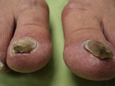 purple-toenail-fungus.jpg