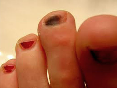 why-are-my-toenails-yellow-causes-and-treatment