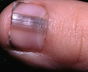 Black lines in fingernails | Skin Conditions discussions ...