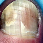 24 Pictures of Nail Fungus in Early & Fully Development Stages | GNFO