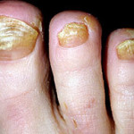 24 Pictures of Nail Fungus in Early & Fully Development Stages | GNFO