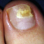 24 Pictures of Nail Fungus in Early & Fully Development Stages | GNFO