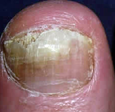 24 Pictures of Nail Fungus in Early & Fully Development Stages | GNFO
