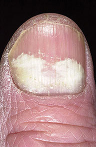 will lamisil spray cure toenail fungus