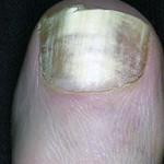 24 Pictures of Nail Fungus in Early & Fully Development Stages | GNFO