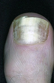 24 Pictures of Nail Fungus in Early & Fully Development Stages | GNFO