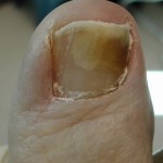 cure-for-infected-toenail