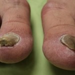 purple-toenail-fungus