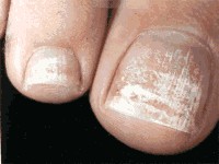 White Spots on Nails