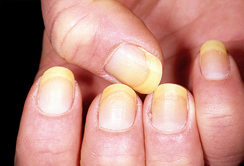 yellow nail is toenail fungus
