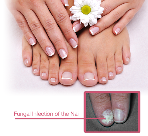 toenail fungus treatment