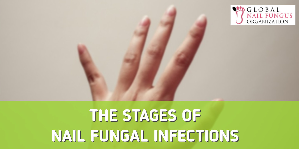 The Stages of a Nail Fungal Infection | GNFO