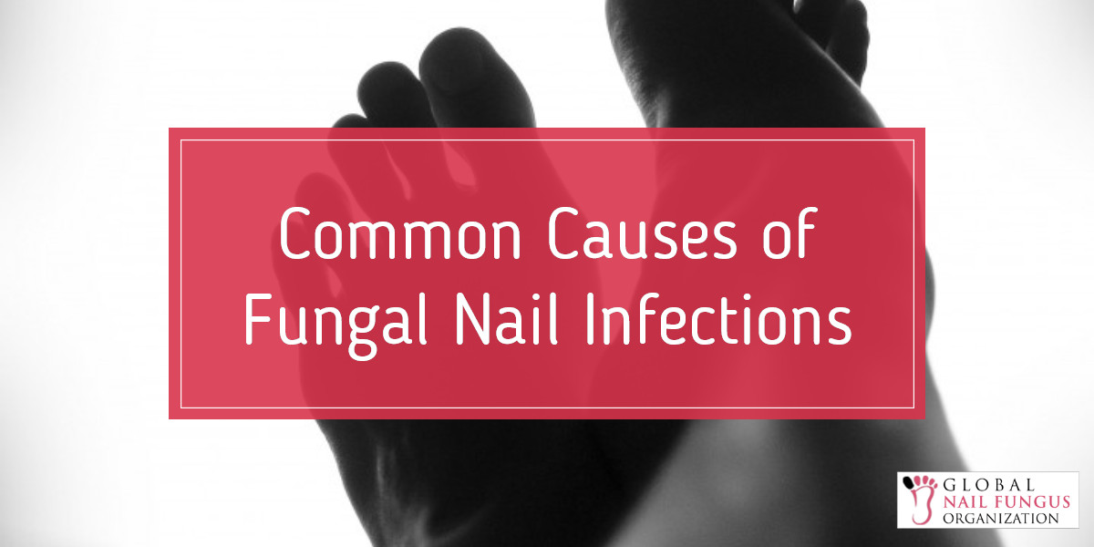 Common Causes of Fungal Nail Infections | GNFO