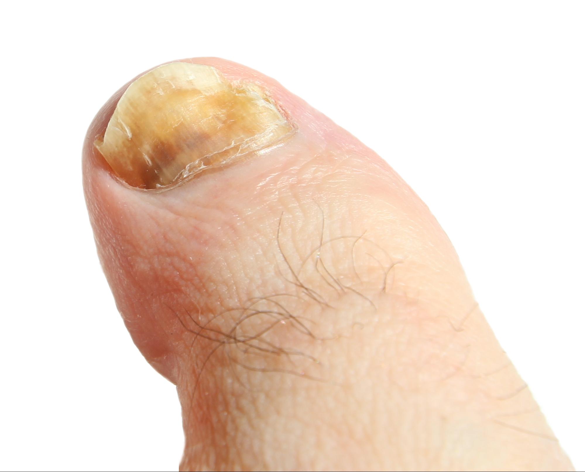 What Toenail Fungus Looks Like