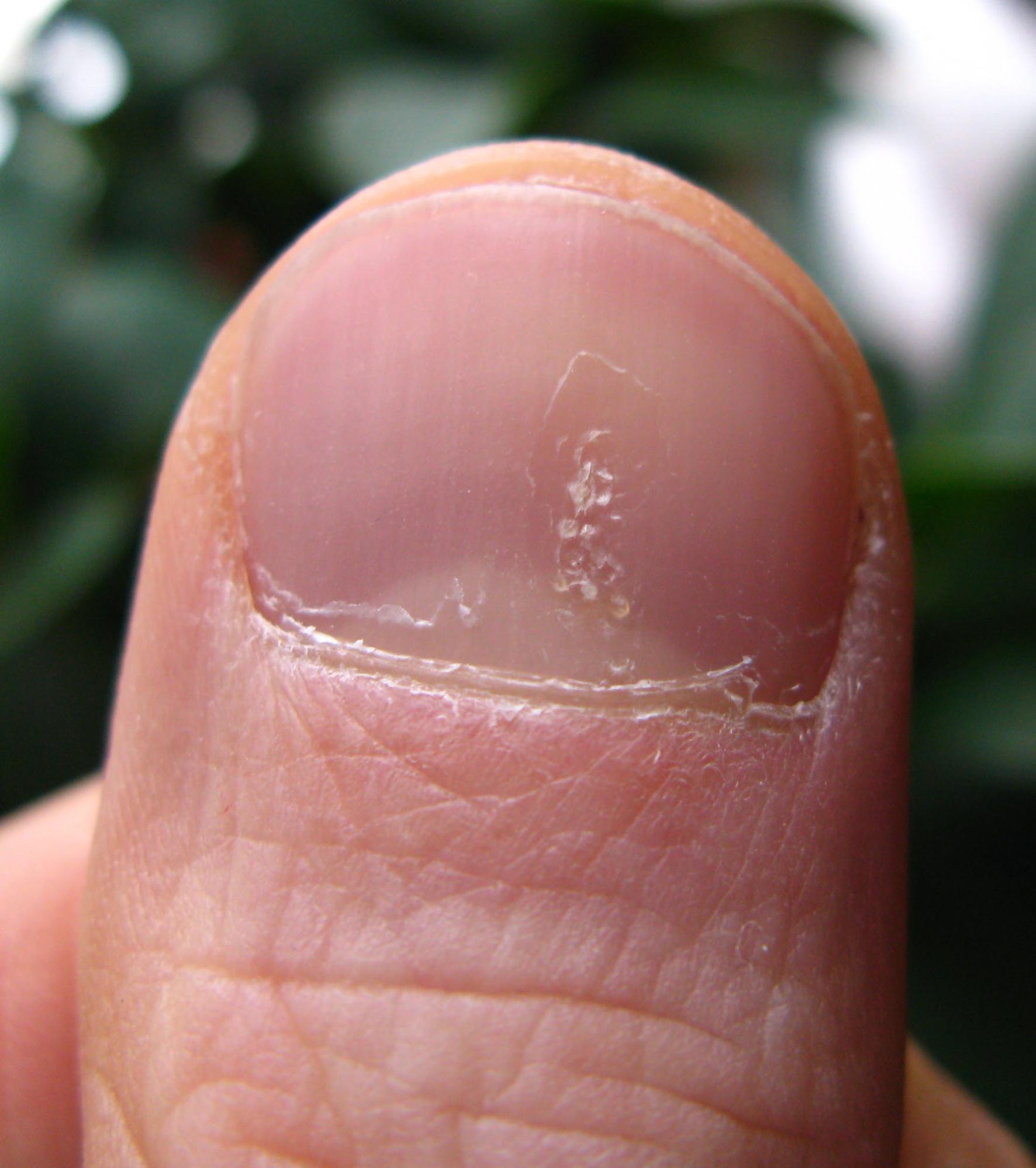 The Ultimate Guide to Understanding and Treating Finger and Toenail Fungus  | GNFO