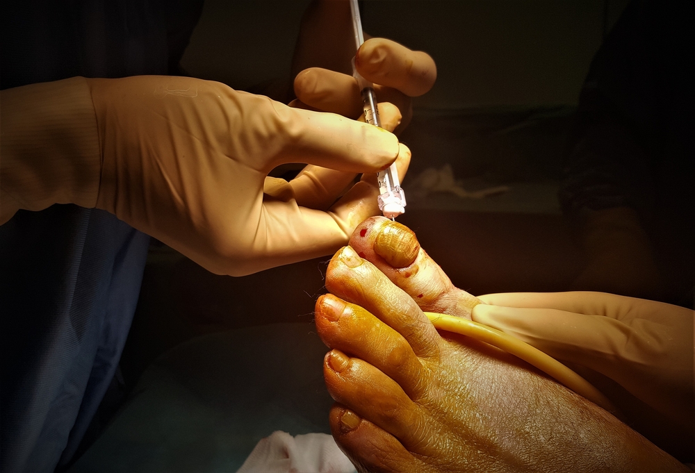 Toenail Removal Surgery Everything You Need To Know GNFO