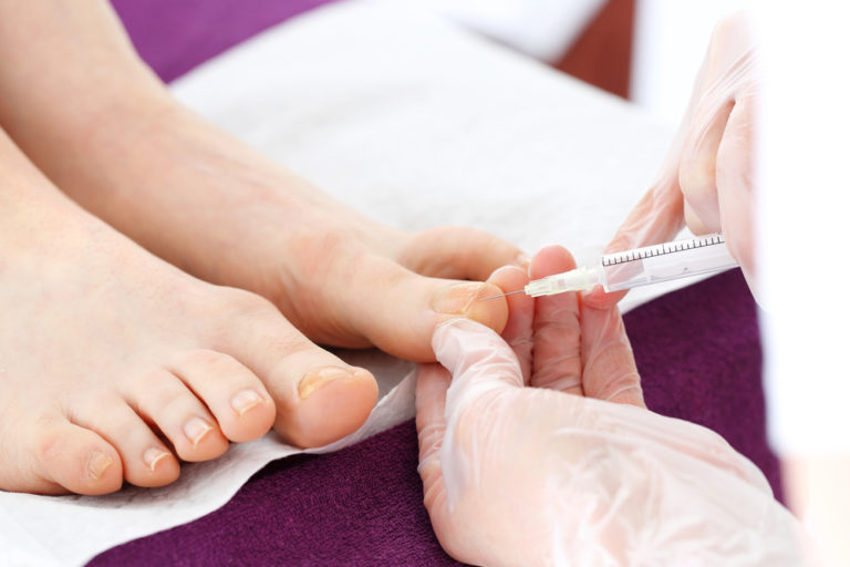 Toenail Removal Surgery - Everything You Need to Know | GNFO